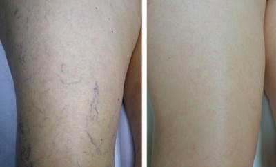 Remedios caseros para las varices