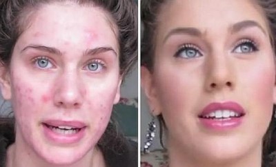 Disimular el acné con maquillaje