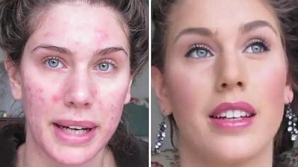 Tips para disimular el acné con maquillaje - Conmicelu