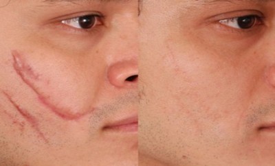 Remedios caseros para eliminar cicatrices de la cara