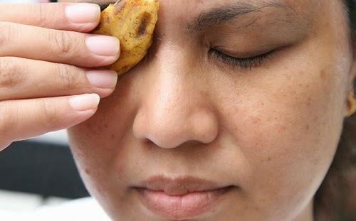 Remedios caseros para la migraña