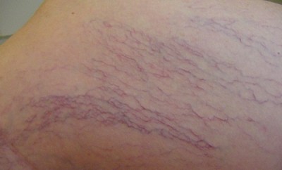 Eliminar las arañas vasculares de forma natural