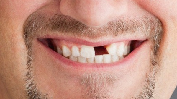 Qué significa soñar que se caen los dientes