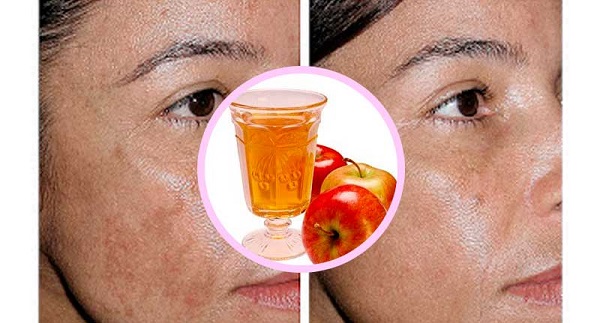 Beneficios del vinagre de manzana para el rostro