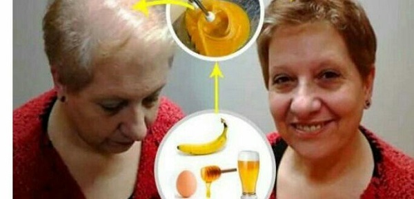 Cómo combatir la alopecia de forma natural