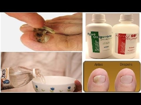 Cómo eliminar los hongos de las uñas con agua oxigenada