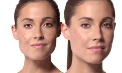 Cómo eliminar manchas y pecas en la cara