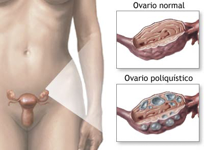 Cómo eliminar quistes de ovarios naturalmente