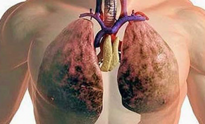 Cómo limpiar los pulmones de la nicotina