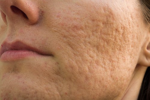 Remedios caseros para eliminar las cicatrices del acné