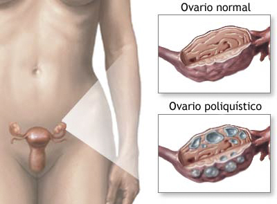 Cómo eliminar los quistes en los ovarios
