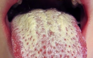Remedios caseros para la lengua blanca