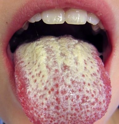 remedios caseros para la lengua blanca