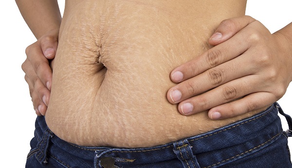 cómo eliminar las estrías en el abdomen después del embarazo