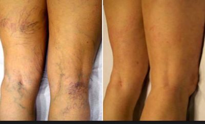 Cómo eliminar las varices de forma natural