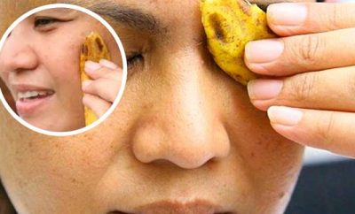 Cómo quitar las verrugas con cáscara de plátano