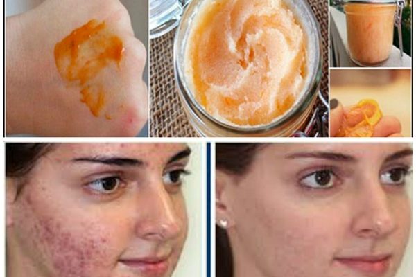 mascarilla de mandarina para el acné