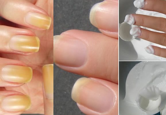 cómo blanquear las uñas amarillas