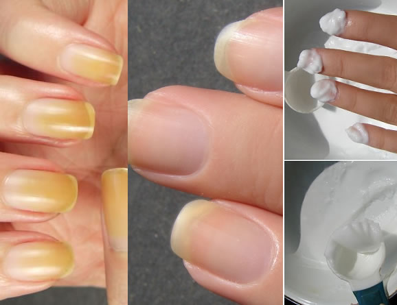 Cómo blanquear las uñas amarillas