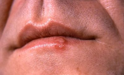 Cómo deshacerse del herpes labial