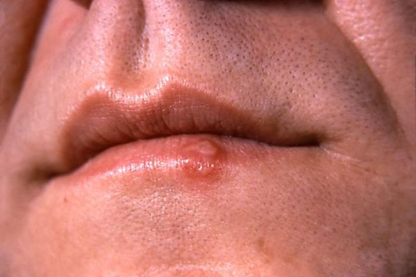 cómo deshacerse del herpes labial