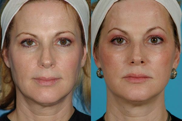 rejuvenecimiento facial láser