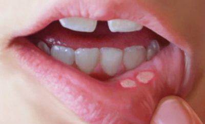 Cómo curar aftas y llagas en la boca