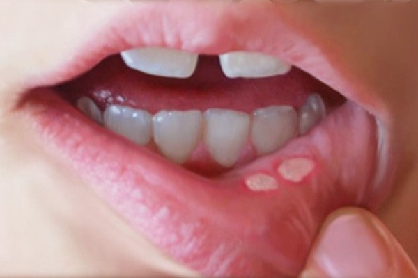 Cómo curar aftas y llagas en la boca