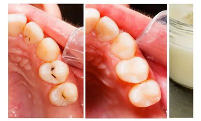 Cómo eliminar las caries de forma casera