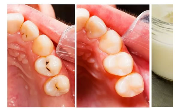 Cómo eliminar las caries de forma casera