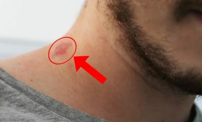 Cómo quitar los chupetones rápido