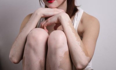 Remedios naturales para el vitiligo