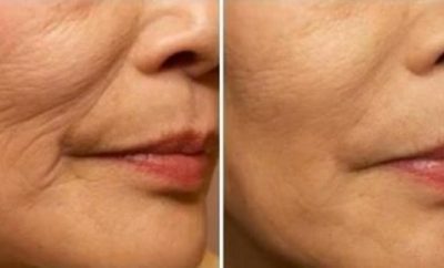 Tratamientos para rejuvenecer el rostro sin cirugía