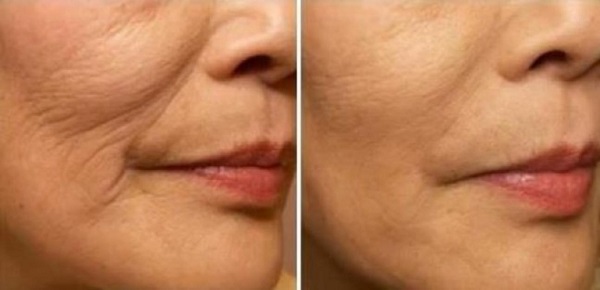 Tratamientos para rejuvenecer el rostro sin cirugía