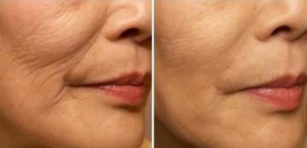 tratamientos para rejuvenecer el rostro sin cirugía