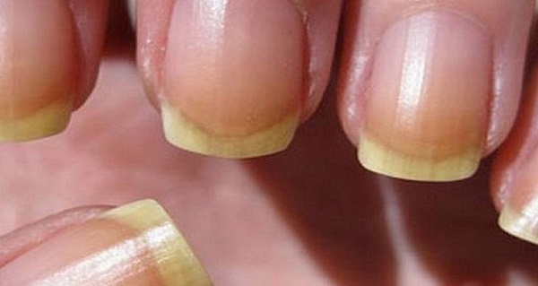 Por qué las uñas se ponen naranjas, uñas amarillentas, uñas de color naranja