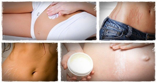 Recetas para prevenir las estrias durante el embarazo