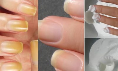 Remedios caseros para blanquear las uñas amarillas