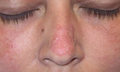 remedios-caseros-para-controlar-el-lupus
