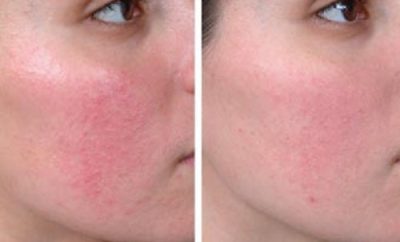 remedios-caseros-para-curar-la-piel-rosacea