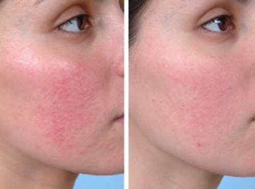 remedios-caseros-para-curar-la-piel-rosacea