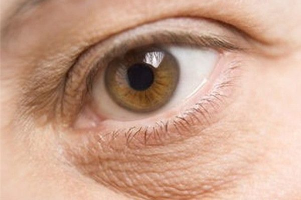 remedios caseros para eliminar la piel seca de los ojos