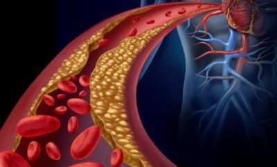 remedios natural para limpiar las arterias obstruidas