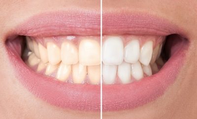 como hacer un blanqueador de dientes natural